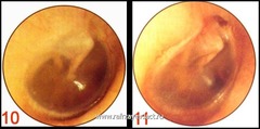 Otita externă - endoscopie ureche - otorinolaringologie - chirurgie cap și gât