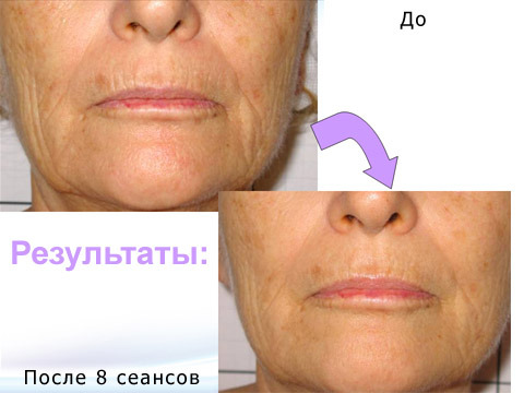 Мезотерапия Мезотерапия