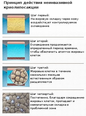 Криолиполиз Криолиполиз