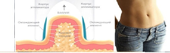 Криолиполиз Криолиполиз