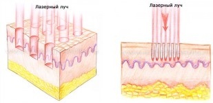 Лазерный – Фракционный Термолиз Лазерный – Фракционный Термолиз