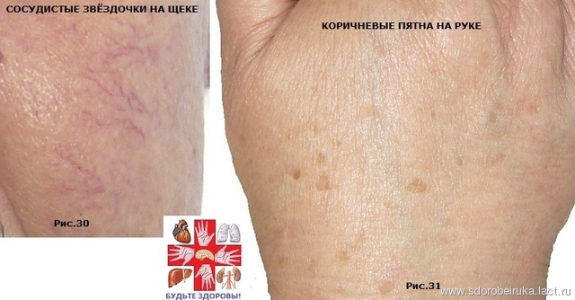 Селезенка – симптомы заболевания Селезенка – симптомы заболевания