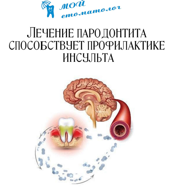 Лечение пародонтита способствует профилактике инсульта. Лечение пародонтита способствует профилактике инсульта.