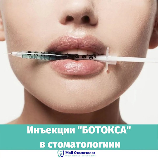 Все чаще стоматологи используют ботулинический токсин для терапевтических целей в своей практике. Все чаще стоматологи используют ботулинический токсин для терапевтических целей в своей практике.