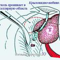 Интракраниальное распространение что это. Смотреть фото Интракраниальное распространение что это. Смотреть картинку Интракраниальное распространение что это. Картинка про Интракраниальное распространение что это. Фото Интракраниальное распространение что это